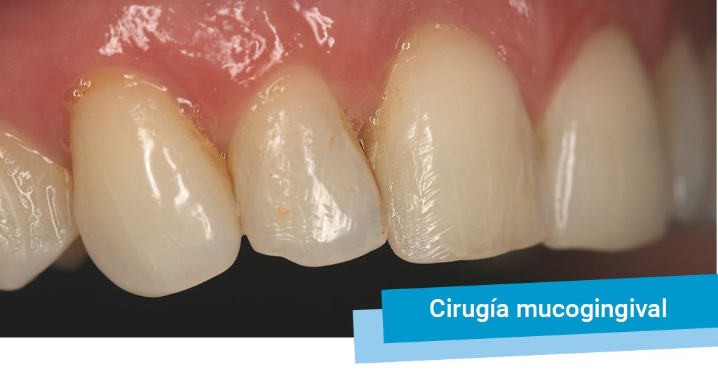 Ciruga mucogingival