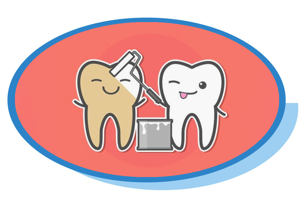 Blanqueamiento dental - dentista oviedo