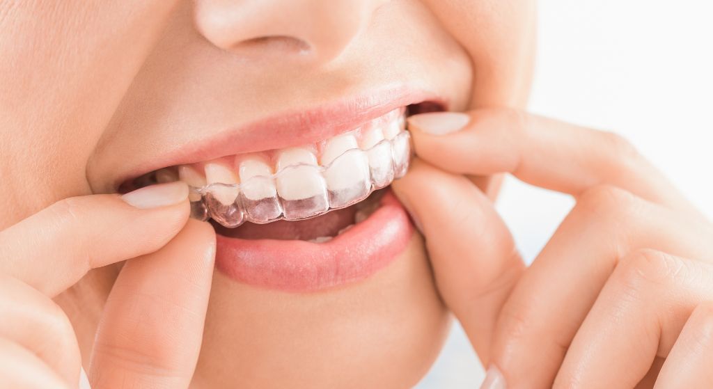 Dentista en Oviedo - Clínica Amoedo Alineadores transparentes o brackets: ¿qué tratamiento funciona mejor?